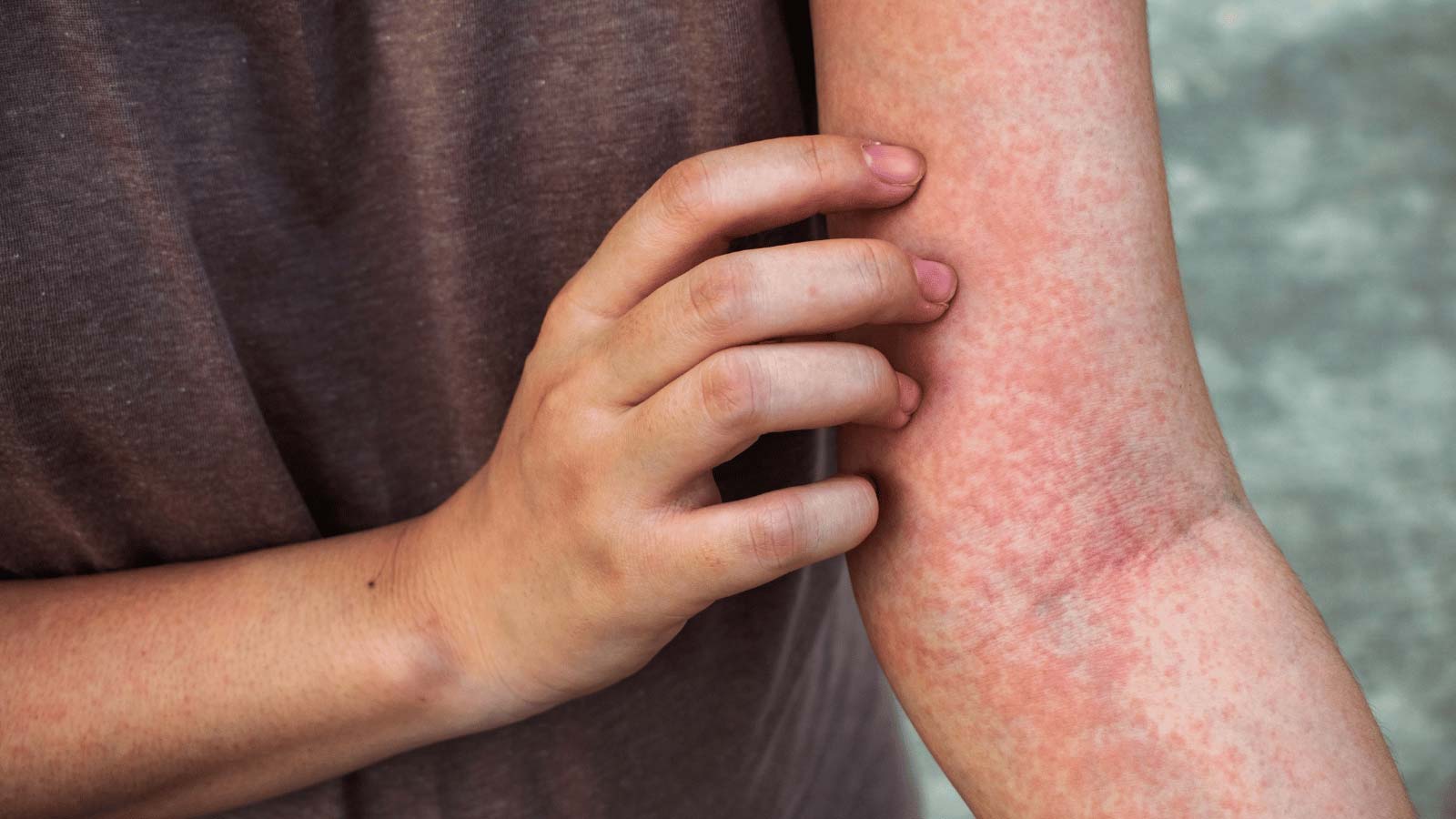 pokeweed-rash-ss1411109588 pokeweed rash picture