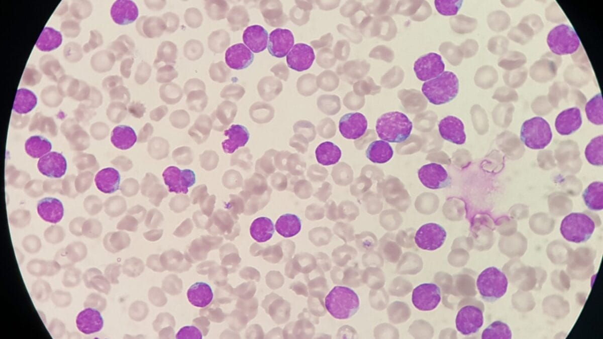 High White Blood Cell Counts in Dogs: 6 Probable Causes 4 High White Blood Cell Counts in Dogs: 6 Probable Causes - leukemia dog ss1883301037