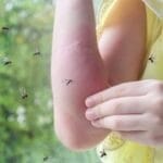 Say Goodbye to Mosquitoes with These DIY Mason Jar Candles 2 Say Goodbye to Mosquitoes with These DIY Mason Jar Candles - girl with rash allergy ss2161884849