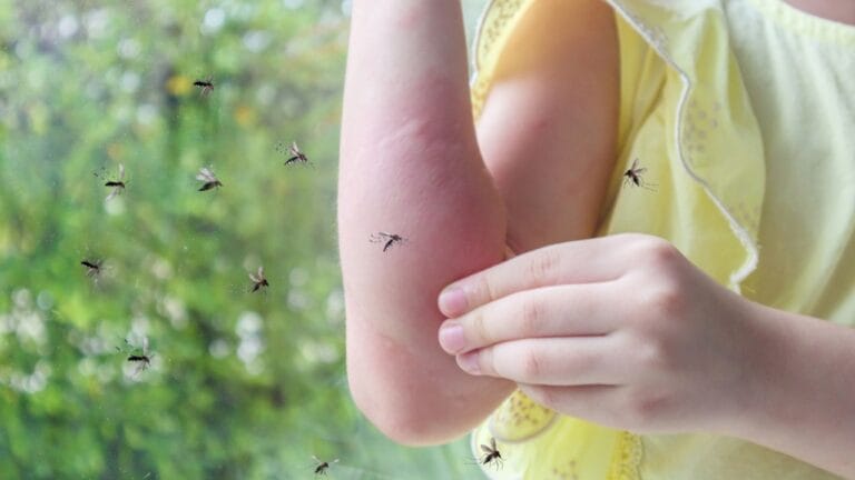 Vanilla is the New Secret Weapon Against Mosquitoes & 4 Backups - girl with rash allergy ss2161884849