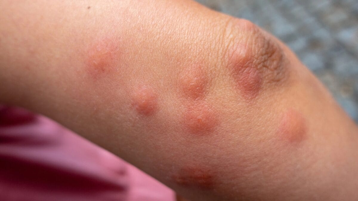 10 Unexpected Ways to Use Irish Spring Soap in Your Home 6 10 Unexpected Ways to Use Irish Spring Soap in Your Home - bug bites dp233554440