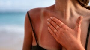 15 Soothing Natural Remedies for Sunburn Relief 1 15 Soothing Natural Remedies for Sunburn Relief - sunburn ss2282134281