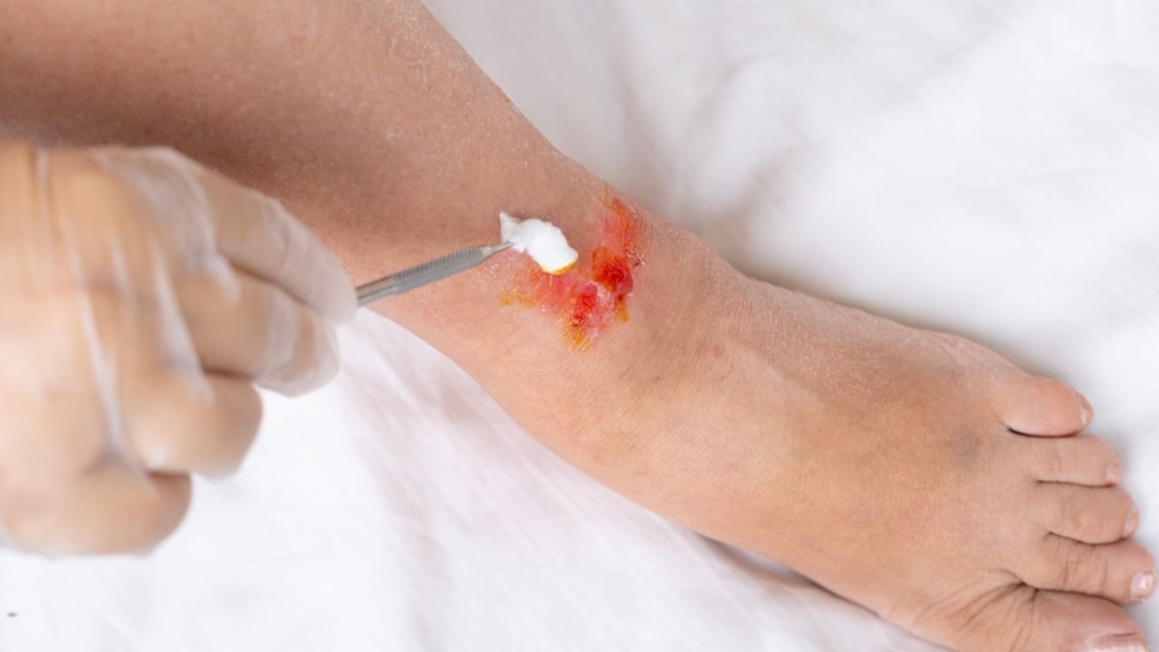 10 Health Benefits of Honey That Will Sweeten Your Life - treating burn wound ss2360502957