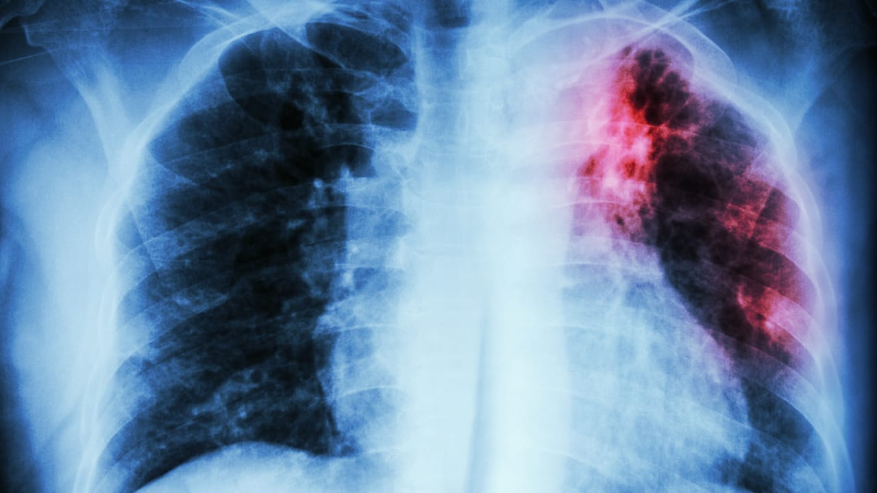 The Dirty Truth: What Happens If You Don’t Wash Your Water Bottle Regularly - tuberculosis lung ss259114169