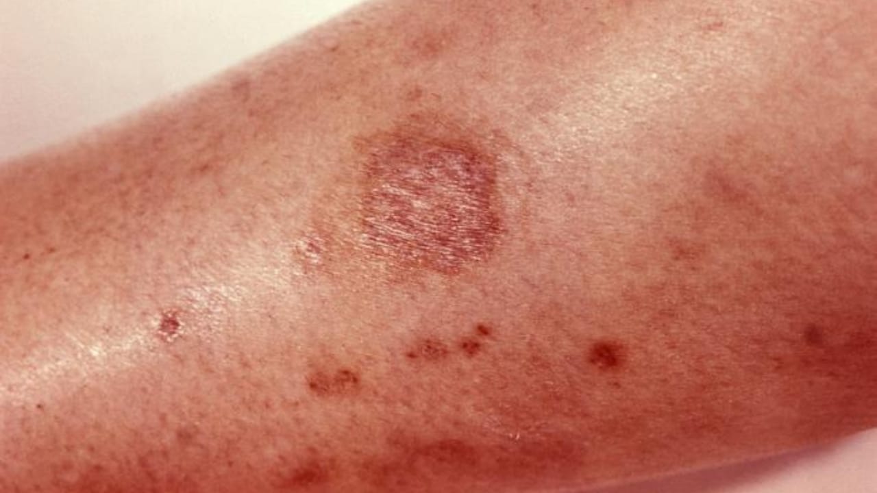 How to Identify a Brown Recluse Spider & Its Web Before It’s Too Late 5 How to Identify a Brown Recluse Spider & Its Web Before It’s Too Late - brown recluse spider bite wc