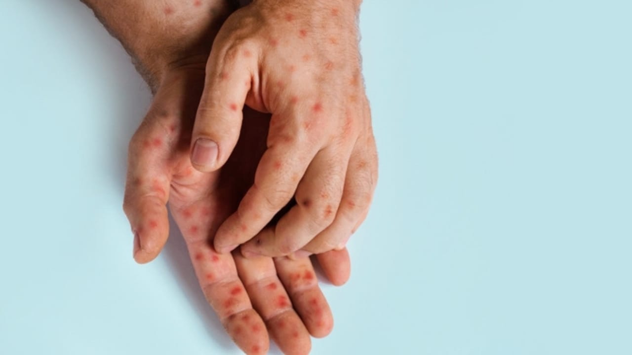 10 Signs of Cat Scratch Fever Every Cat Owner Should Know 3 10 Signs of Cat Scratch Fever Every Cat Owner Should Know - Red Spots Blisters on the Skin ss2427723057