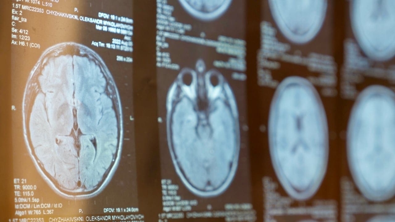 Natural Enzyme Blocker Found in Flowers Offers New Hope for MS & Cancer Therapy 2 Natural Enzyme Blocker Found in Flowers Offers New Hope for MS & Cancer Therapy - multiple sclerosis ss2517380891