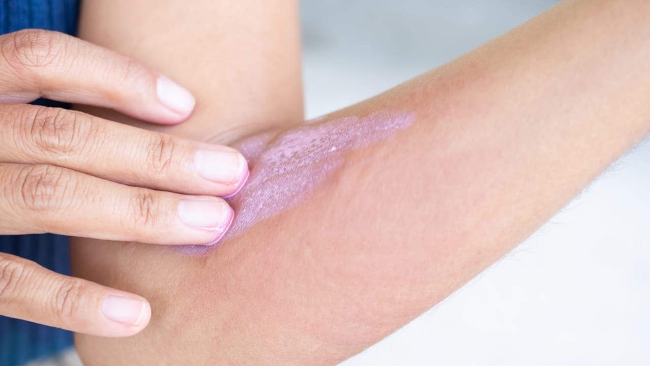 51% of Americans Lack These 15 Emergency Supplies at Home 9 51% of Americans Lack These 15 Emergency Supplies at Home - Applying cream on itchy arm dp575660706 dnoh